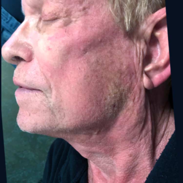 After treatment