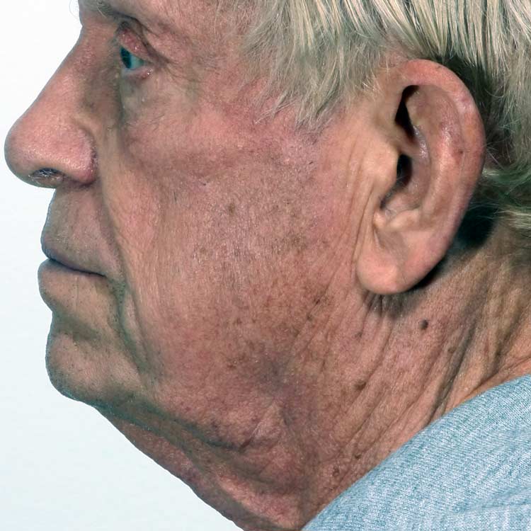 Before treatment