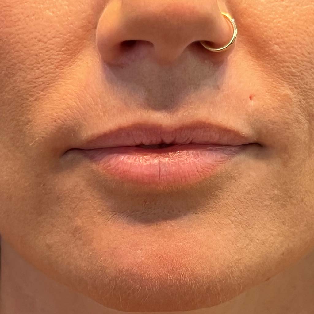 Before treatment