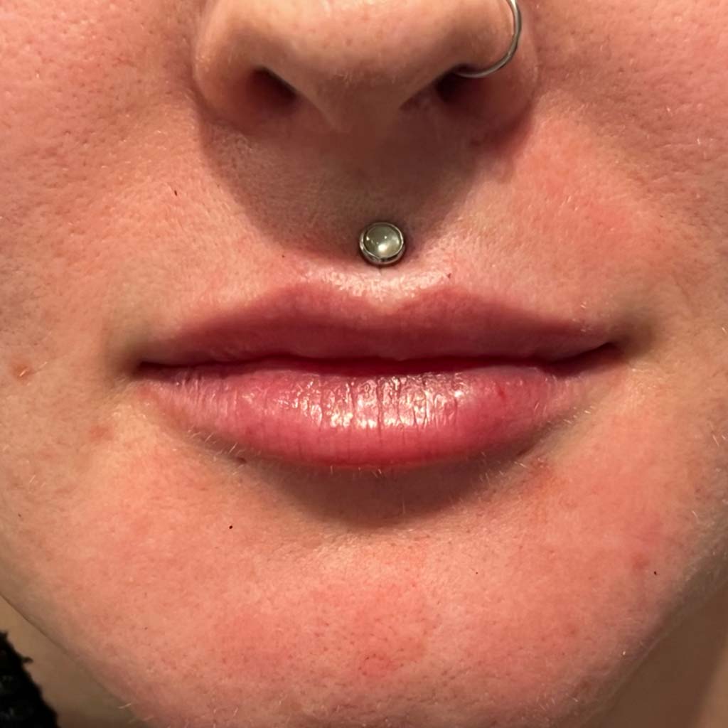 After treatment