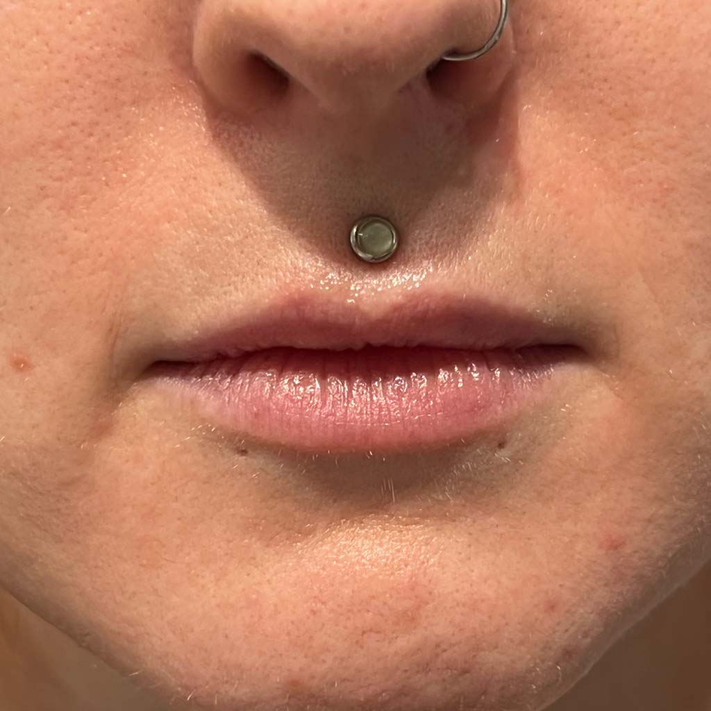 Before treatment