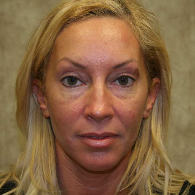 Before treatment